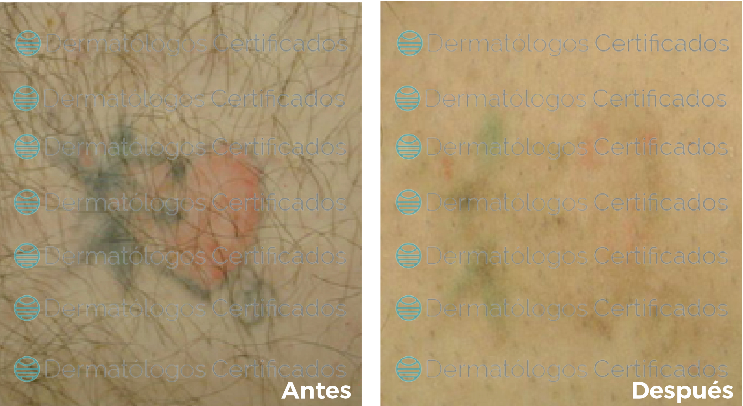 eliminación de tatuajes