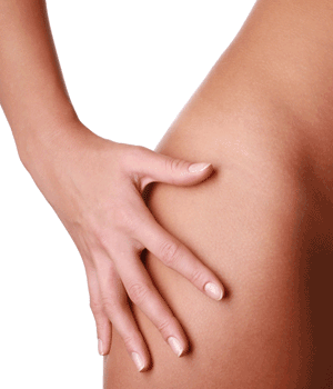 peeling contra estrías